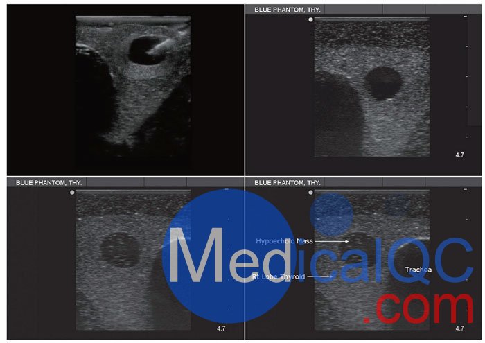 BPT195甲狀腺穿刺模型，BPT195超聲引導穿刺模體影像圖