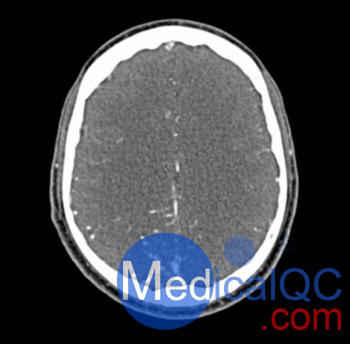 WEK50-04 CTA頭模，帶AVM CTA頭模，WEK50-04 CT血管造影頭模成像效果圖