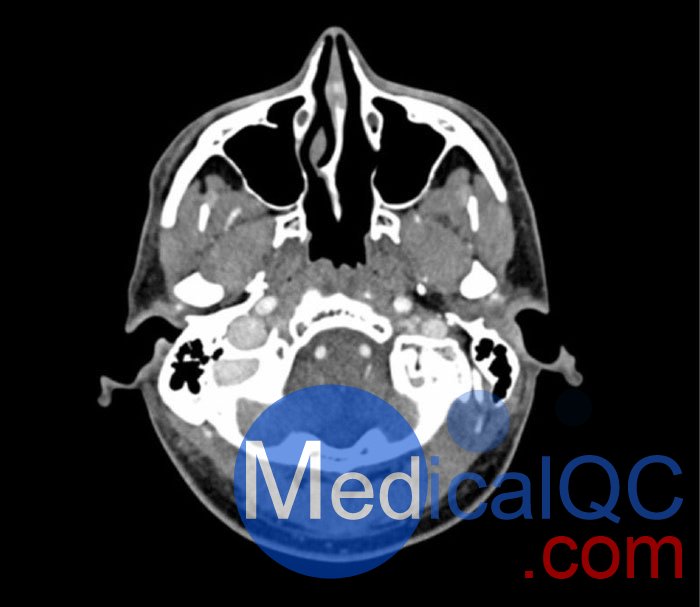 WEK50-04 CTA頭模，帶AVM CTA頭模，WEK50-04 CT血管造影頭模成像效果圖