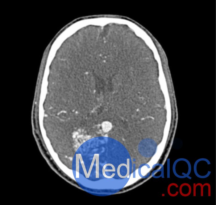 WEK-5005腦血管造影頭模，WEK-5005頭模， CTA AVM頭模成像效果圖