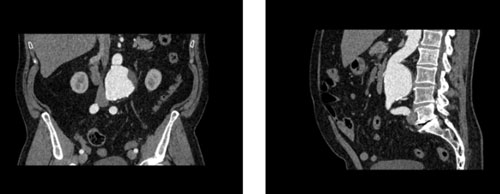 WEK53-05腹部模體,WEK53-05動脈瘤腹部模體,WEK53-05 CT血管造影模型成像