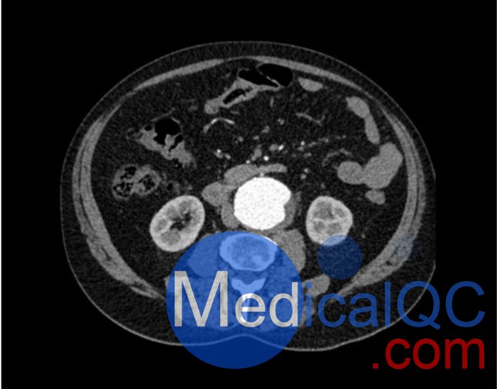 WEK53-05腹部模體，WEK53-05動脈瘤腹部模體