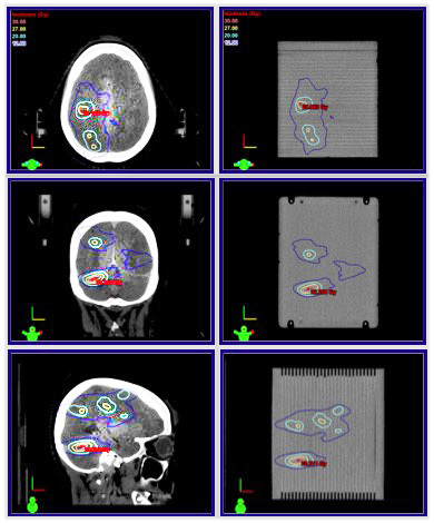 Cirs 037多病變腦QA模型，Cirs 037多病灶SRS治療計(jì)劃QA模體